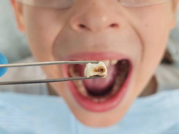 Best Emergency Treatment for Dental Infections or Abscesses in Ruskin, FL